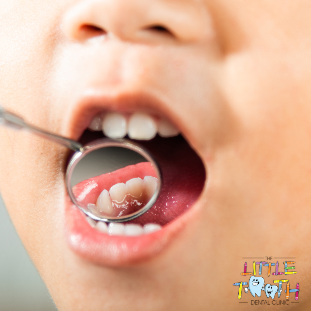 Tooth Decay - Teeth Problems for Kids - The Big Tooth